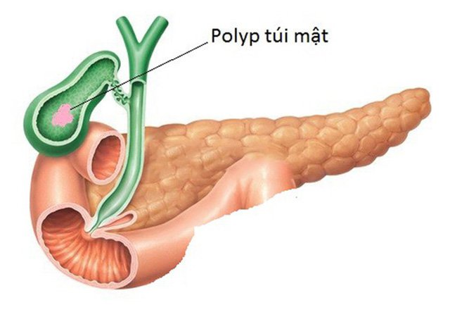 Tìm hiểu chi tiết polyp túi mật là gì? 