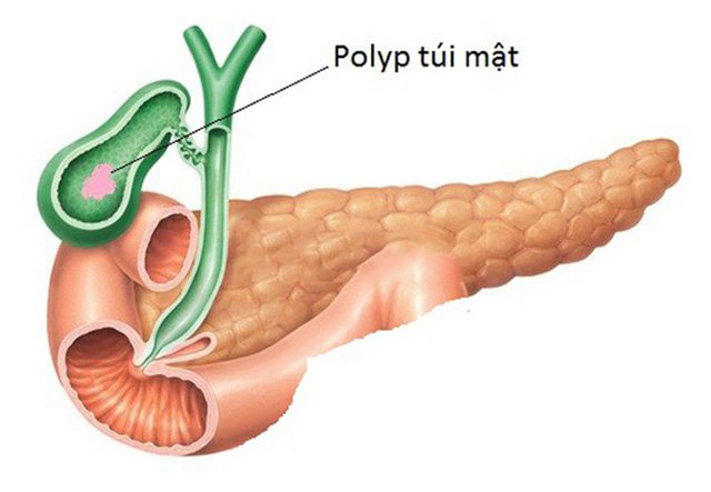 Polyp túi mật là gì? Nguyên nhân và cách điều trị polyp túi mật