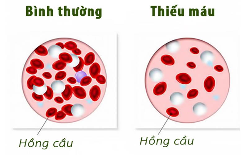 Ý nghĩa chỉ số RDW thấp là gì? 