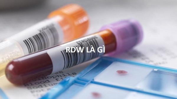 RDW là gì? Chỉ số RDW thấp MCV bình thường là bệnh gì?