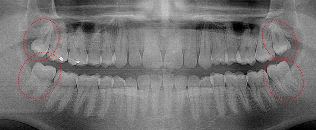 Wisdom Teeth Age 40 Comprehensive Guide to Diagnosis, Treatment, and Prevention